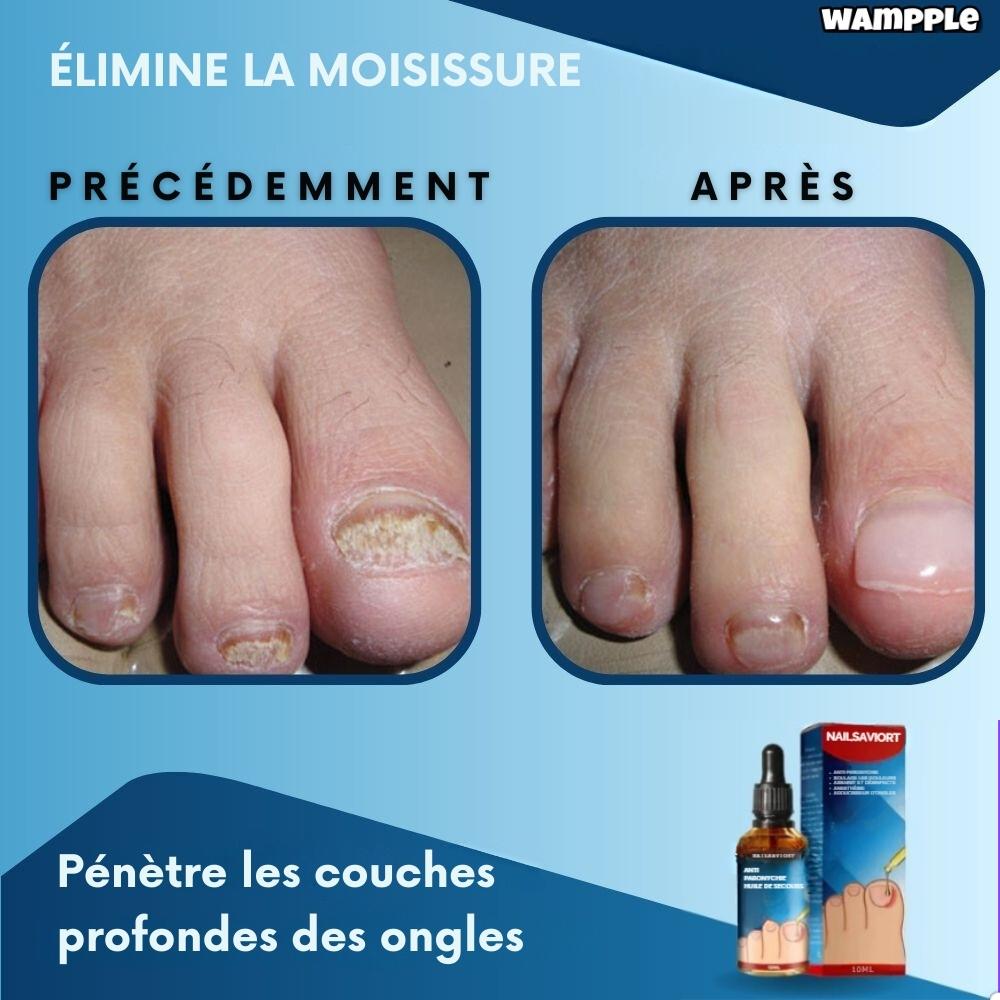 NailSaviort™ - Guérit les ongles des pieds et des mains | 1+1 GRATUIT TEMPORAIRE